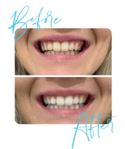 GLOSMILE Teeth Whitening Mousse