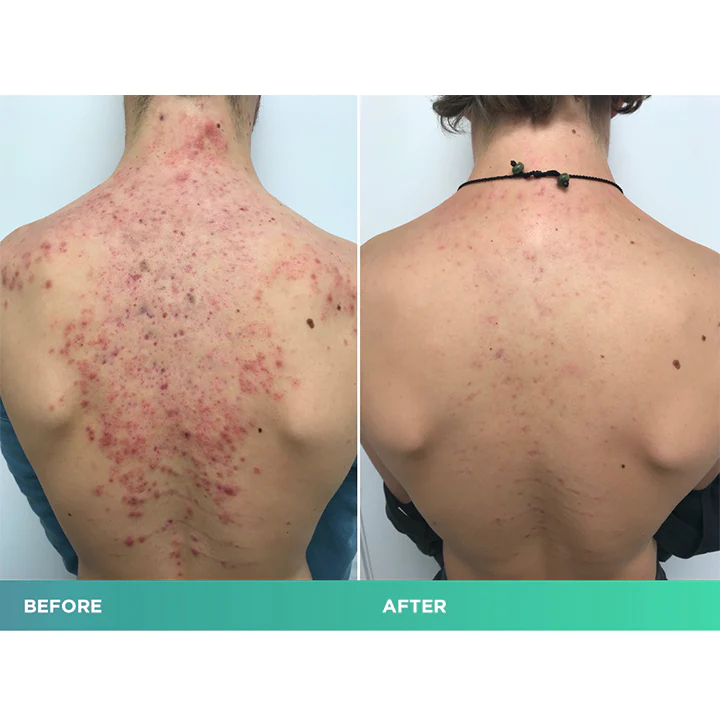 ClearSkin Bacne Treatment Spray