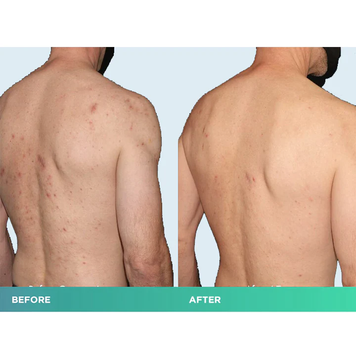 ClearSkin Bacne Treatment Spray