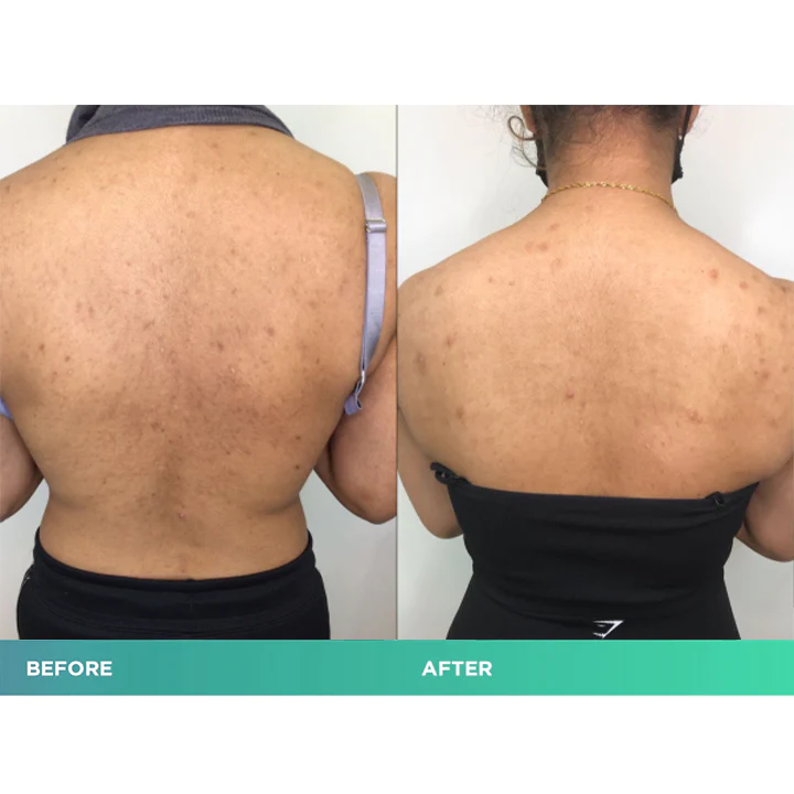 ClearSkin Bacne Treatment Spray