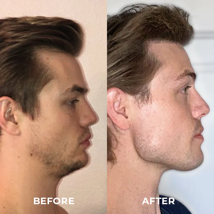 ShapeZ Jawline Exerciser