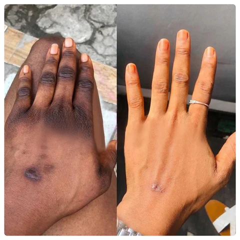 Nigrifree Acanthosis Nigricans Therapy Cream