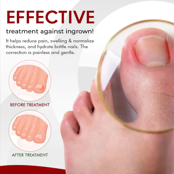 NailCare Ingrown Relief Oil