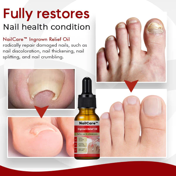 NailCare Ingrown Relief Oil