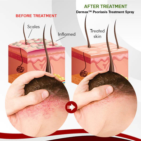 Dermax Psoriasis Treatment-Spray