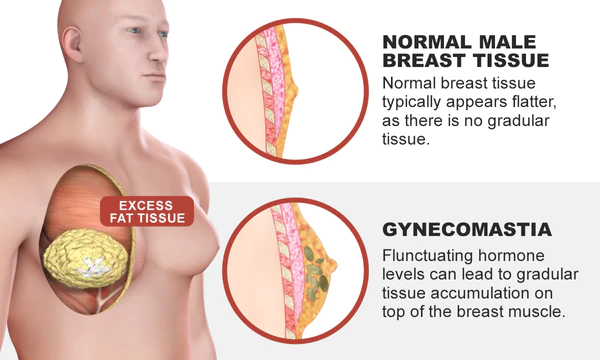 Oveallgo TurmericMax Gynecomastia Compress Patch