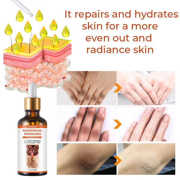 Zoviia Acanthosis Nigricans Therapy Oil