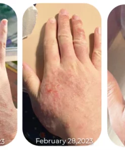 GFOUK Eczema Therapy Spray