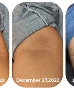 Zoviia Acanthosis Nigricans Therapy Oil