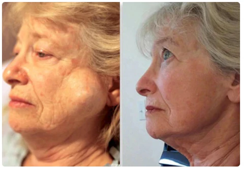 RochFit Lymph Detoxification Ginger Oil