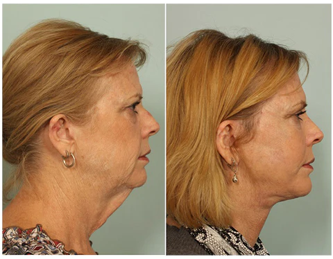 GFOUK EMSculpt Sleeping VFace Beauty Device