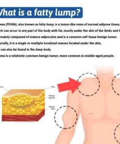 Herbal Lipoma Removal Spray