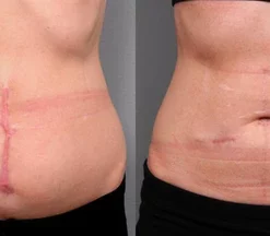 Medical Grade Silicone Scar Gel