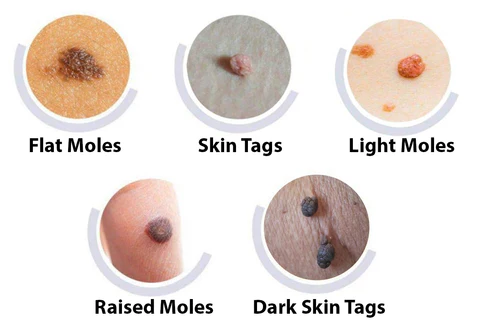 ClearDerm Skin Tag Removal Patch