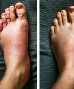 CC Acupressure Kidney Care Belt