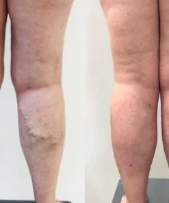 VenaCure Varicose Vein Cream